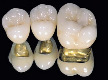 metalkeramičke krunice