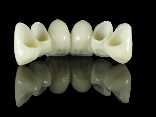 Mostovi-za-zube---e0f449d7d2767c67f4d2c457e6d9f07c53d978e3