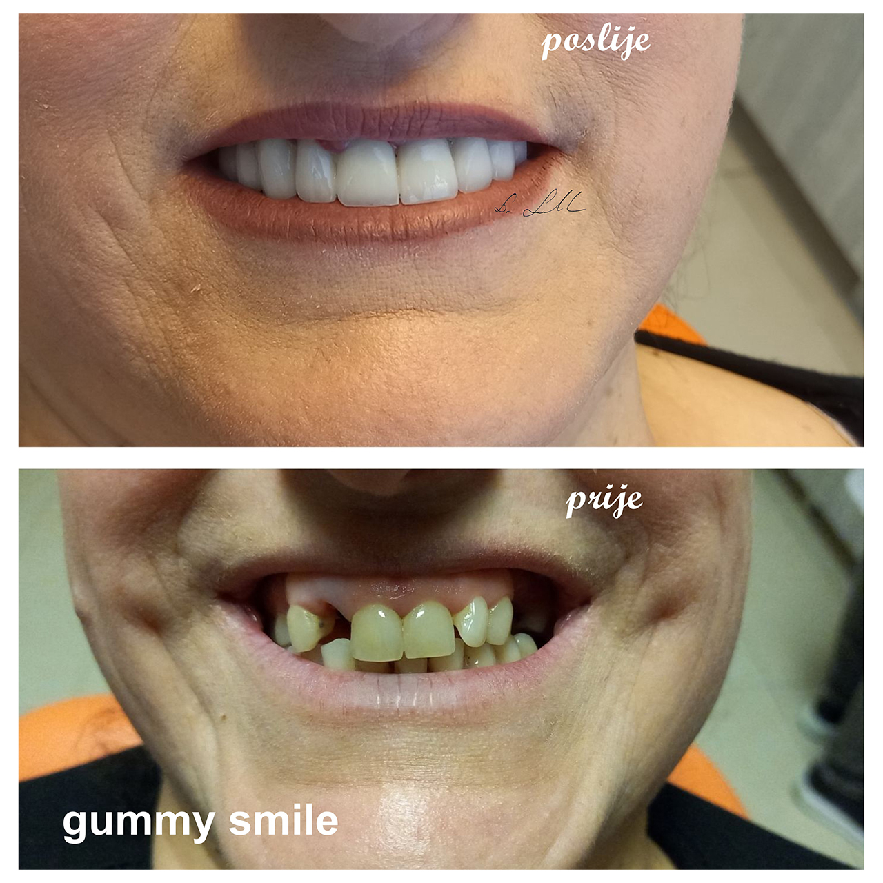 Gummy smile Dental estetc centar