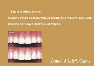 gummy smile 2