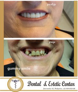 gummy smile pre i posle
